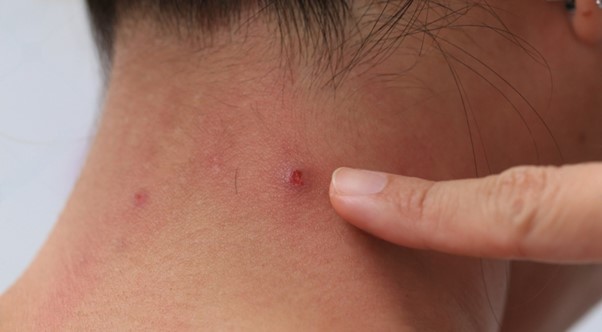 acne on your neck